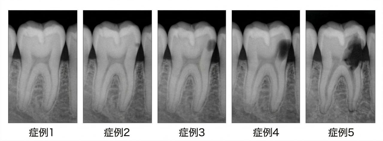 虫歯の進行度5段階を示すレントゲン画像（概念図）