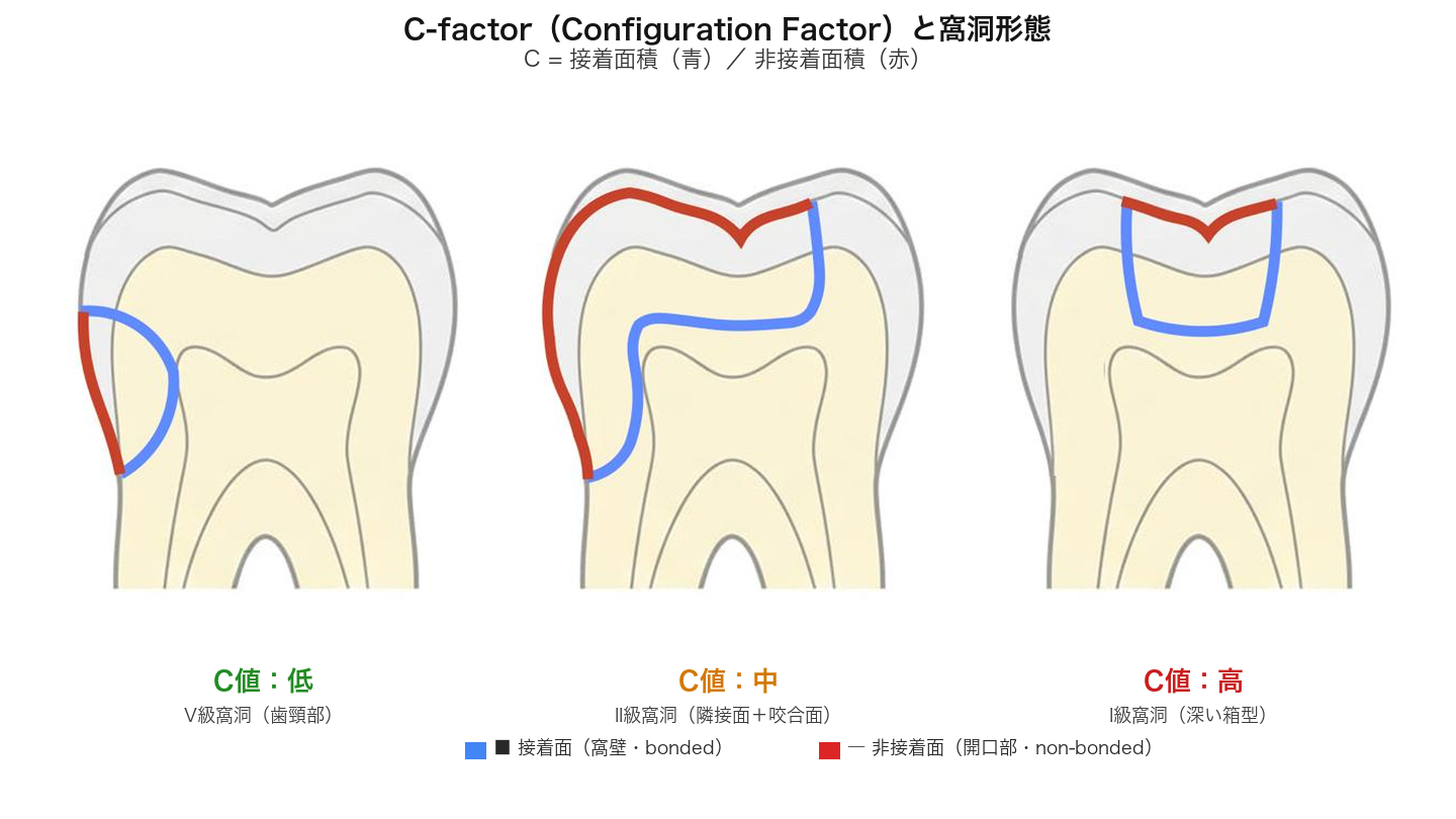 C-factorと窩洞形態の模式図（Class V: 低C-factor、Class II: 中程度、Class I: 高C-factor）