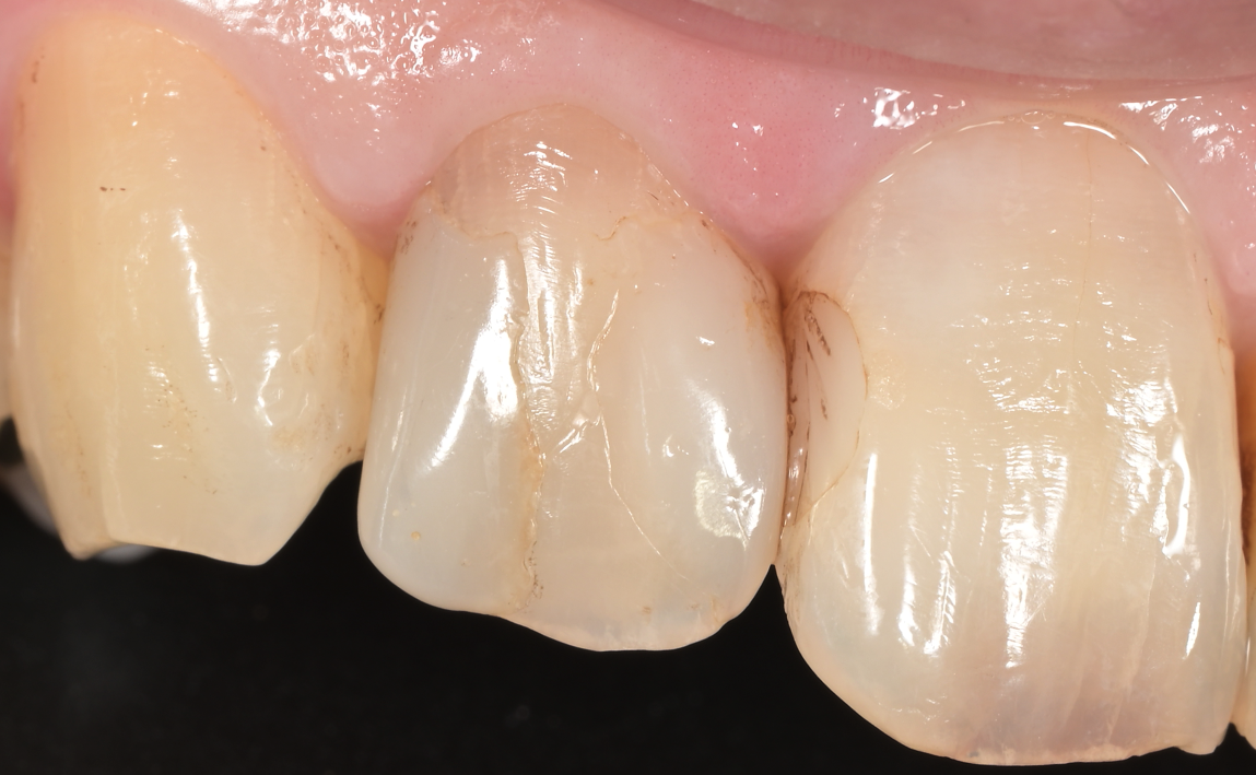前歯DB治療前：虫歯・欠けがある状態（術前）