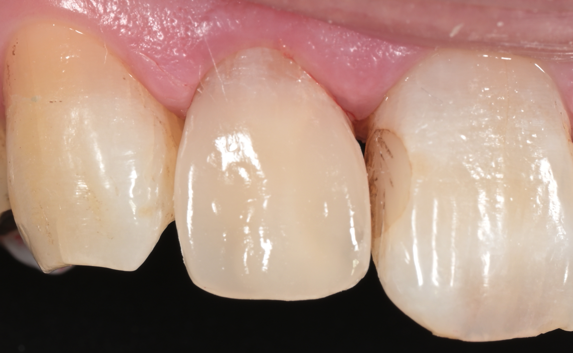 前歯DB術後：自然な白い歯に修復された仕上がり