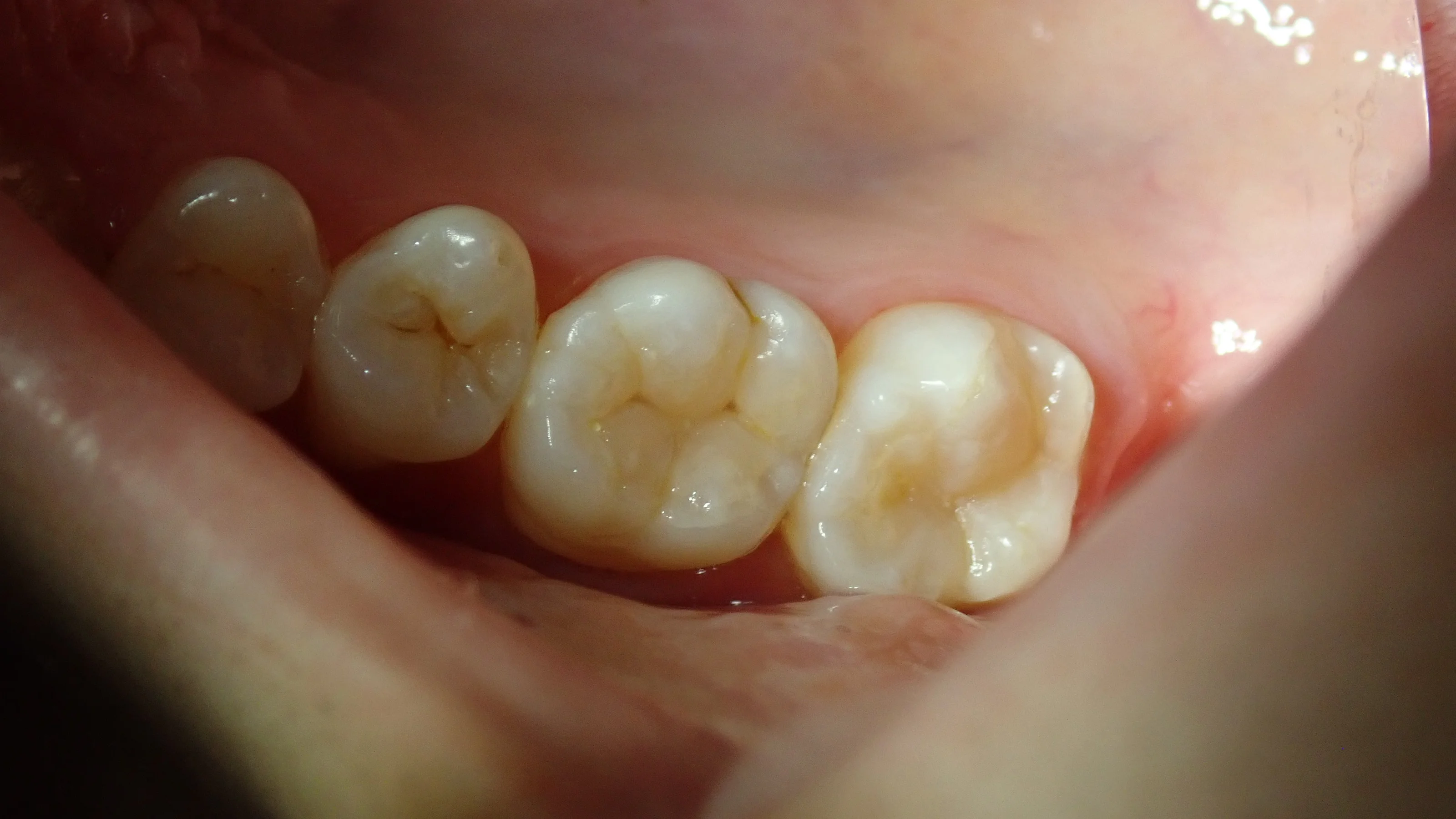 ダイレクトボンディング(処置後3年経過)|坂寄歯科医院(取手市藤代)