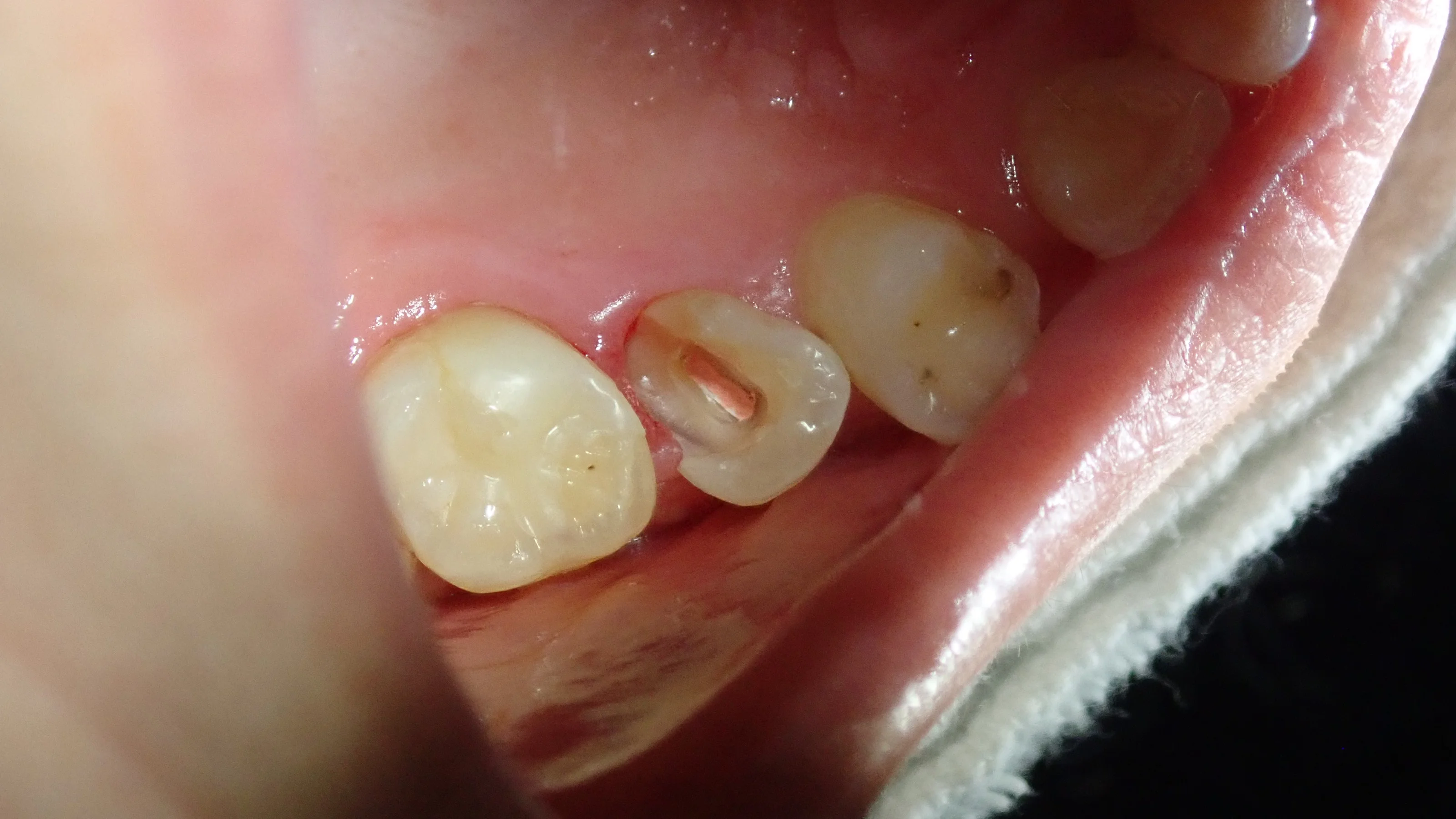 上顎小臼歯ダイレクトボンディング|坂寄歯科医院(取手市藤代) - 画像2