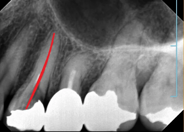 神経の治療⑤|坂寄歯科医院(取手市藤代) - 画像3
