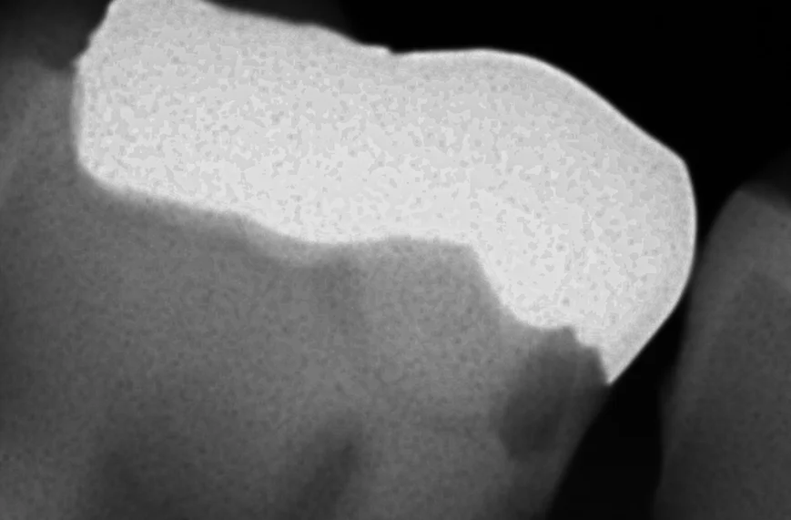 難易度の高い白い詰め物。|坂寄歯科医院(取手市藤代) - 画像6