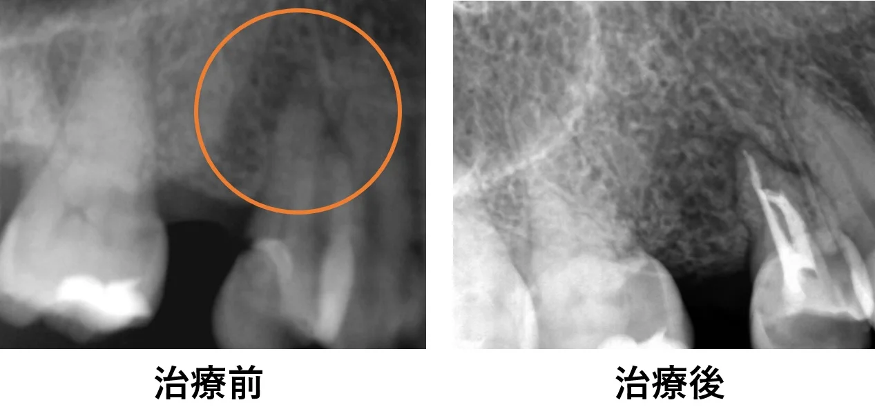 ダイレクトボンディング④|坂寄歯科医院(取手市藤代) - 画像8