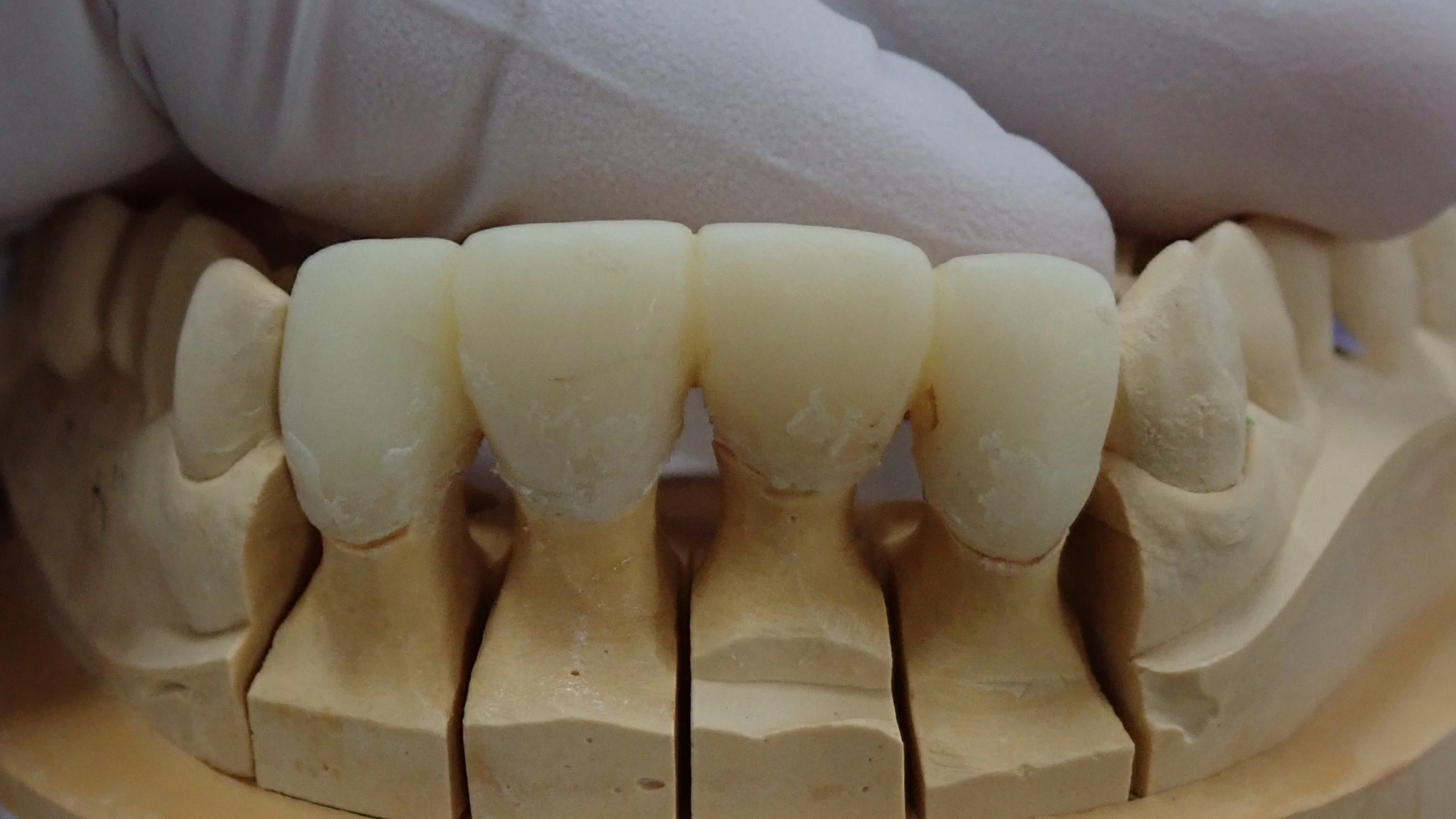 上の前歯の自費診療(セラミック)|坂寄歯科医院(取手市藤代) - 画像2
