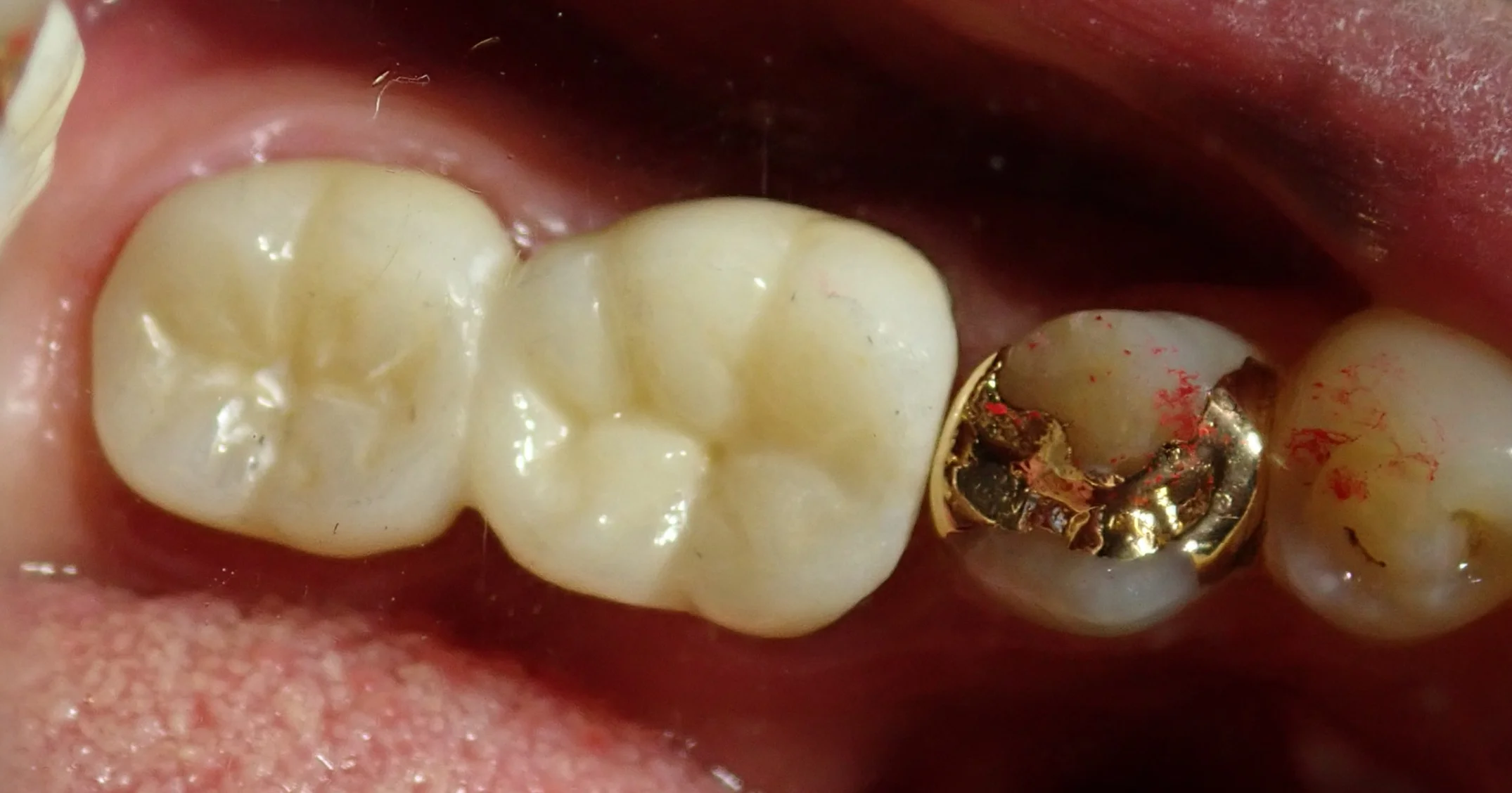 その抜歯ちょっと待って！｜坂寄歯科医院（取手市藤代） - 画像7