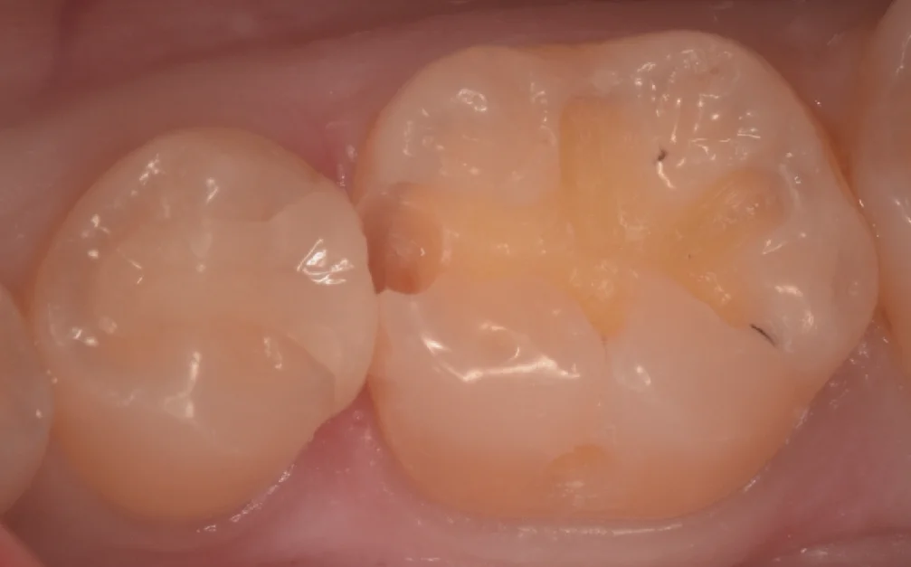 歯科医師の歯を1日で本物の歯のように。|坂寄歯科医院(取手市藤代) - 画像2