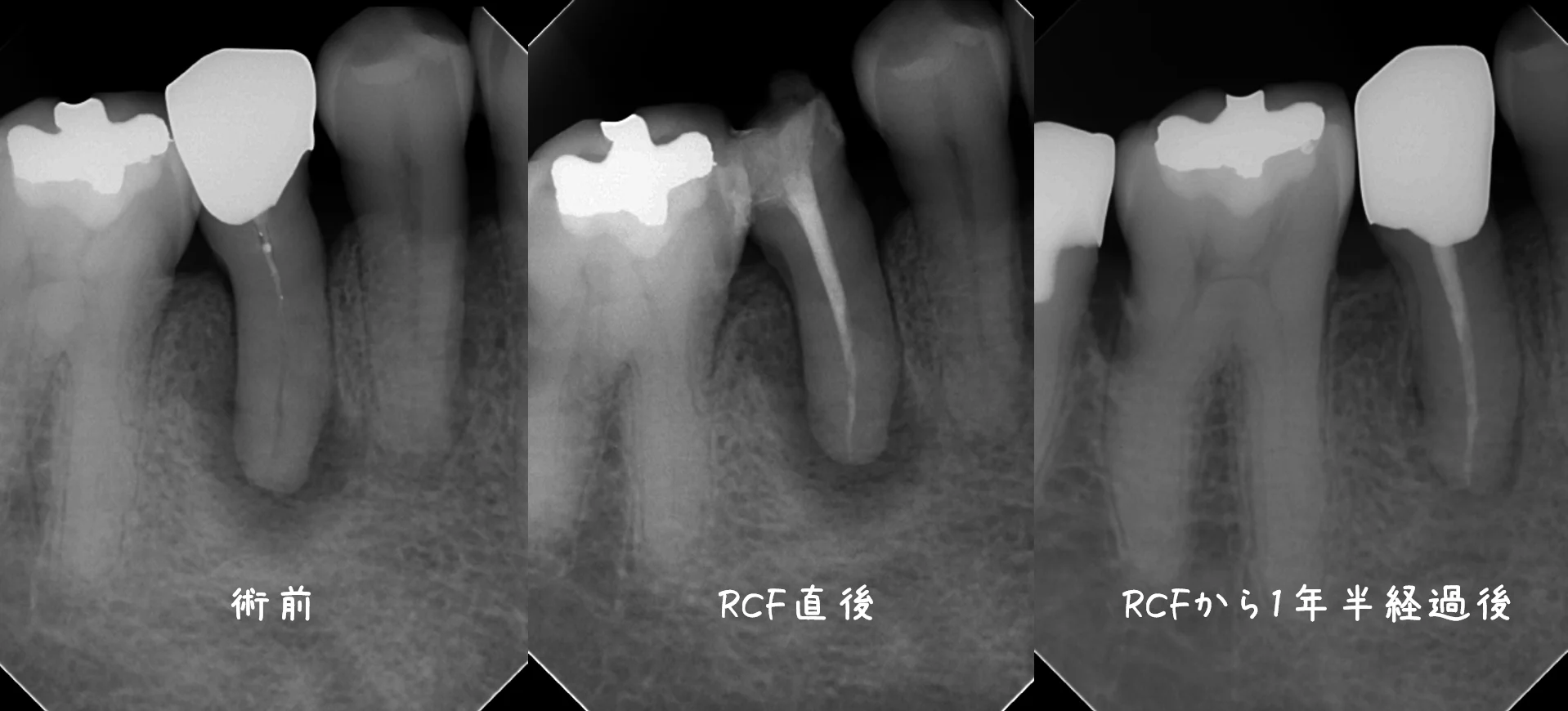 閉鎖根管の治療には根気が必要|坂寄歯科医院(取手市藤代) - 画像5