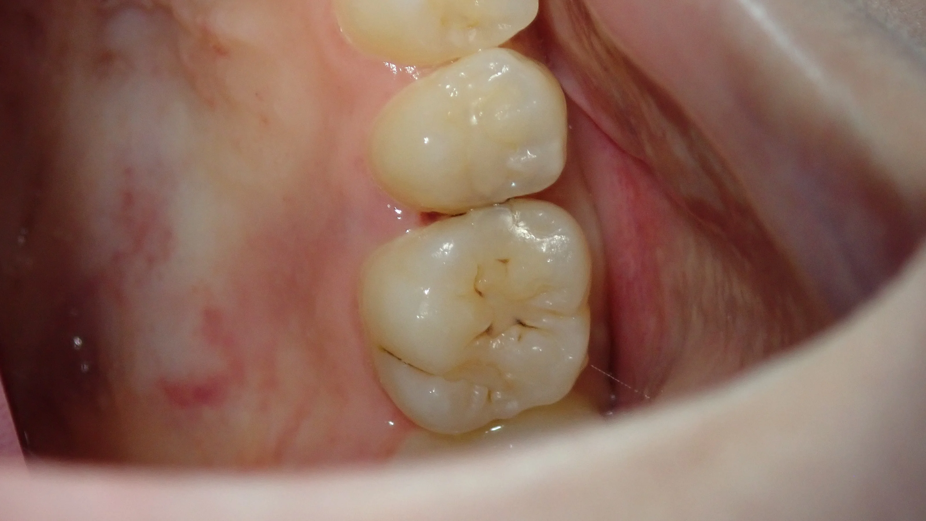 コンポジットレジン②｜坂寄歯科医院（取手市藤代）