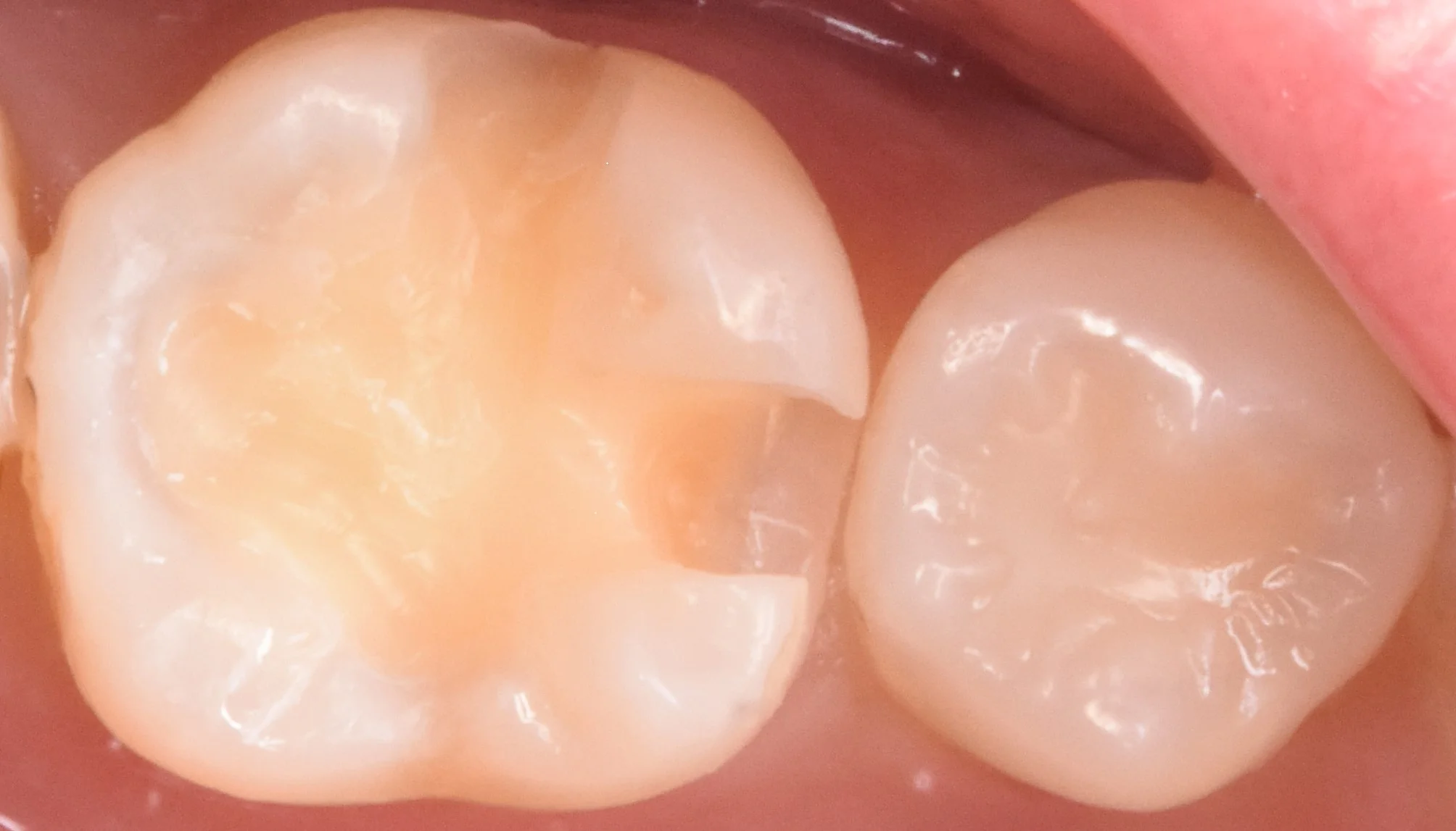 奥歯を白い詰め物で治療。|坂寄歯科医院(取手市藤代) - 画像2