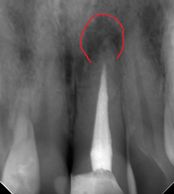 前歯の根管治療|坂寄歯科医院(取手市藤代) - 画像2
