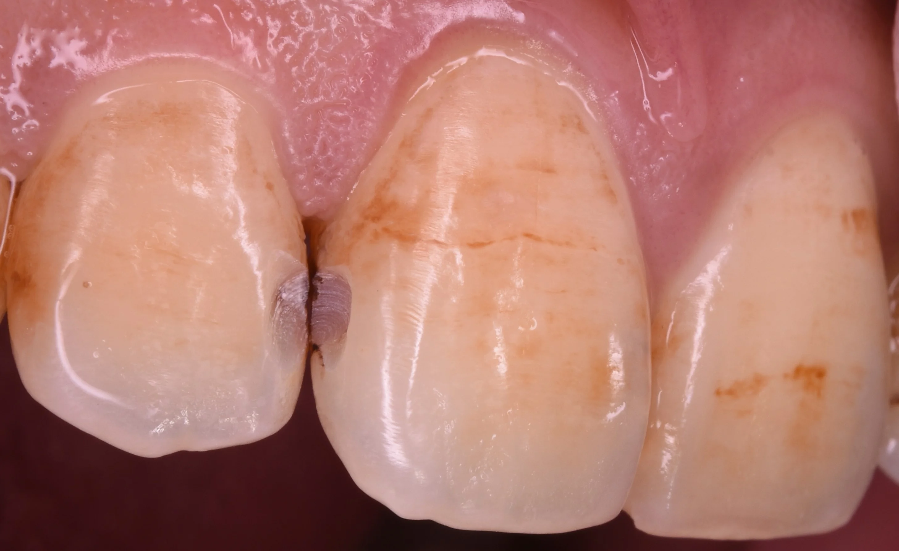 前歯の虫歯の治療で可能な限り歯を温存したケース。｜坂寄歯科医院（取手市藤代） - 画像2