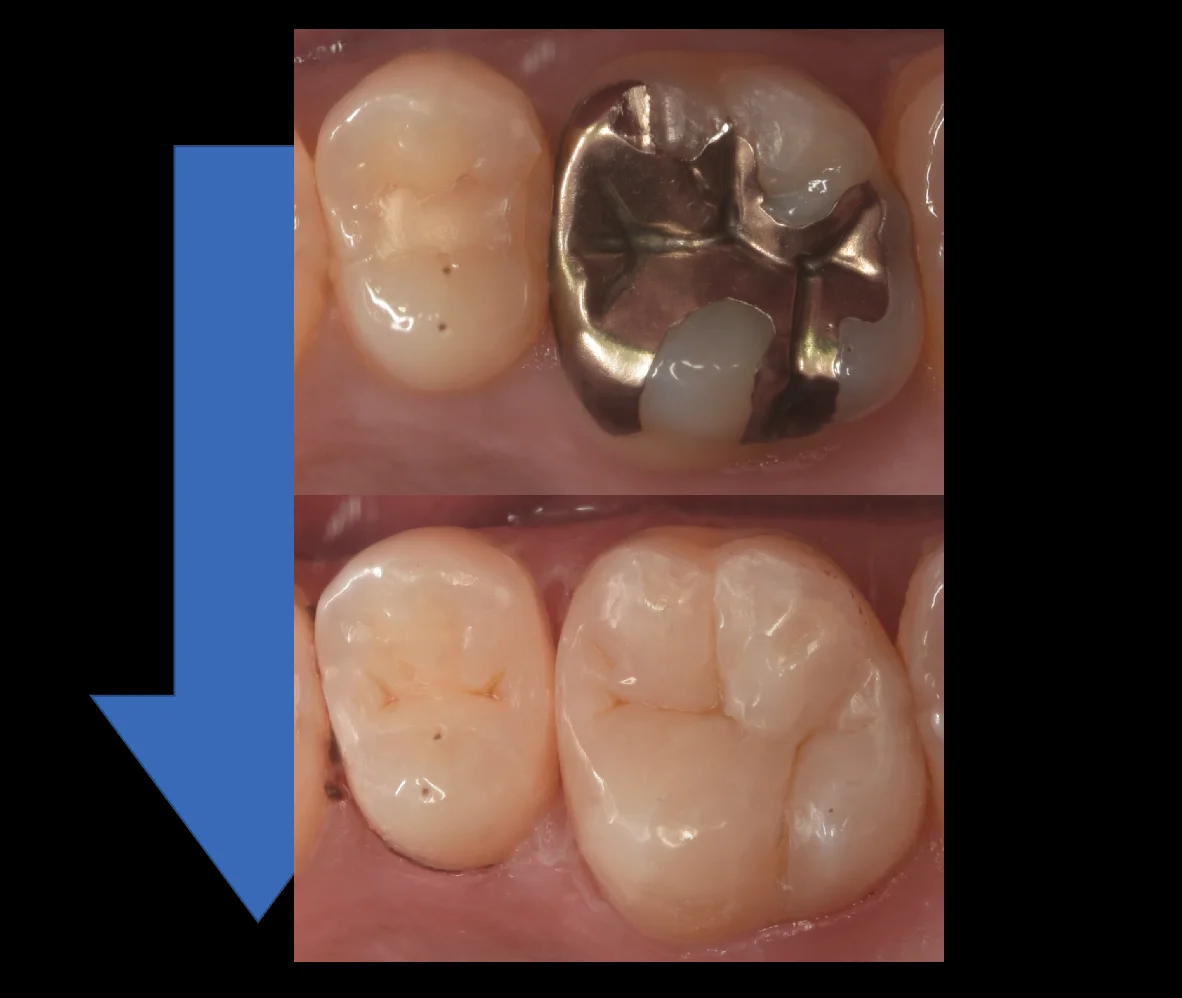 金属の詰め物を白い詰め物に。｜坂寄歯科医院（取手市藤代） - 画像5