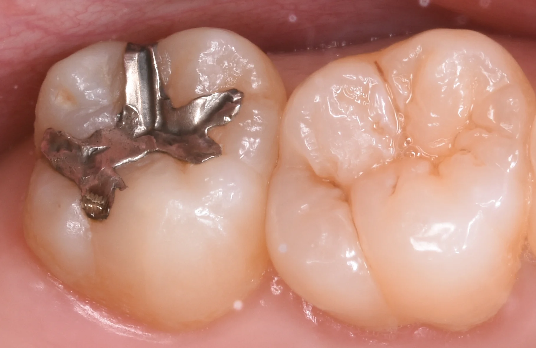 上の奥歯を金属から白い詰め物に。｜坂寄歯科医院（取手市藤代）