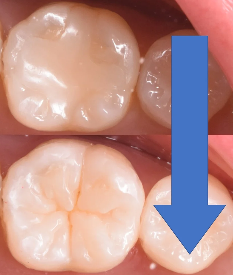 奥歯を白い詰め物で治療。|坂寄歯科医院(取手市藤代) - 画像4