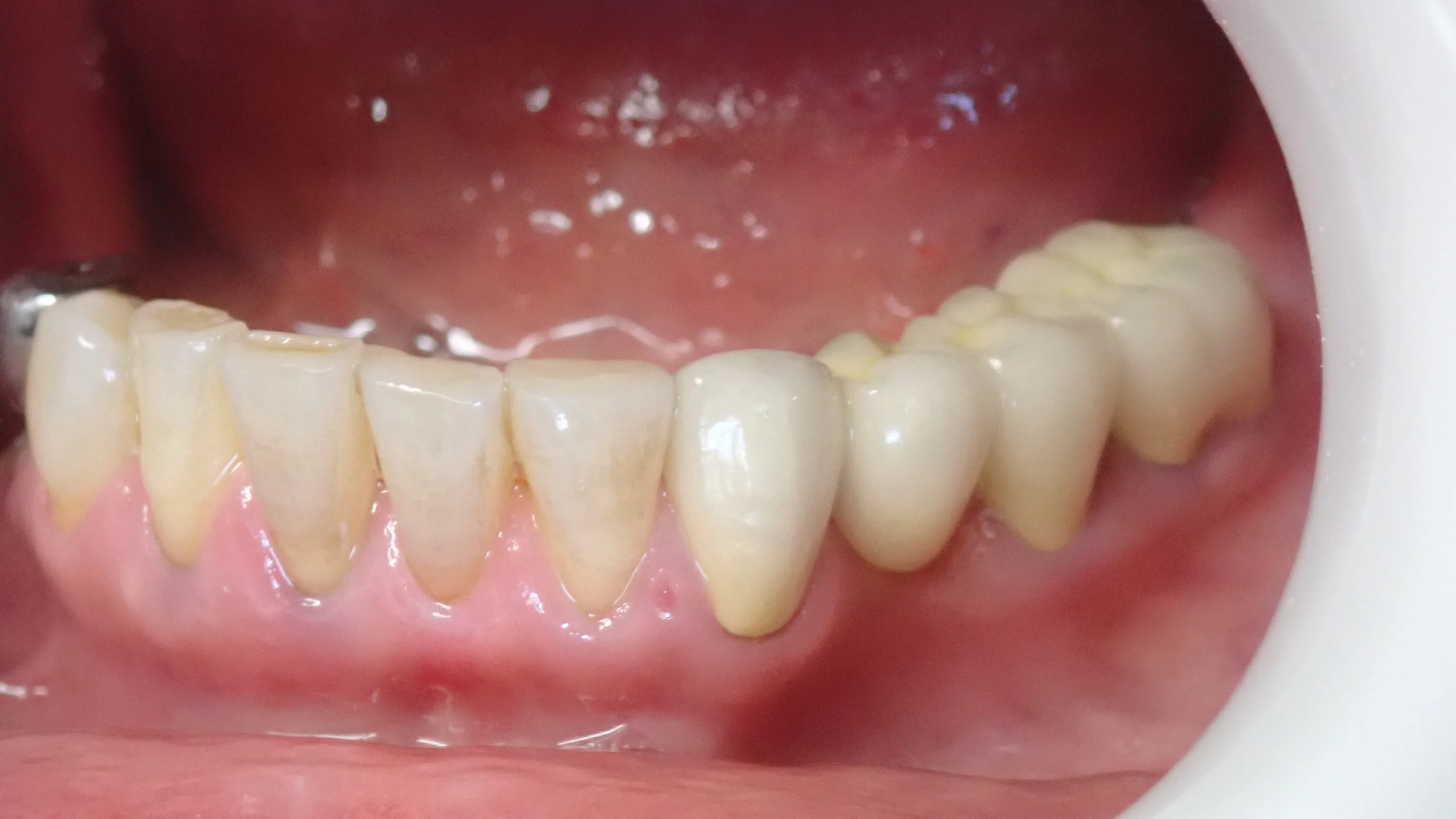 メタルボンドブリッジ｜坂寄歯科医院（取手市藤代）