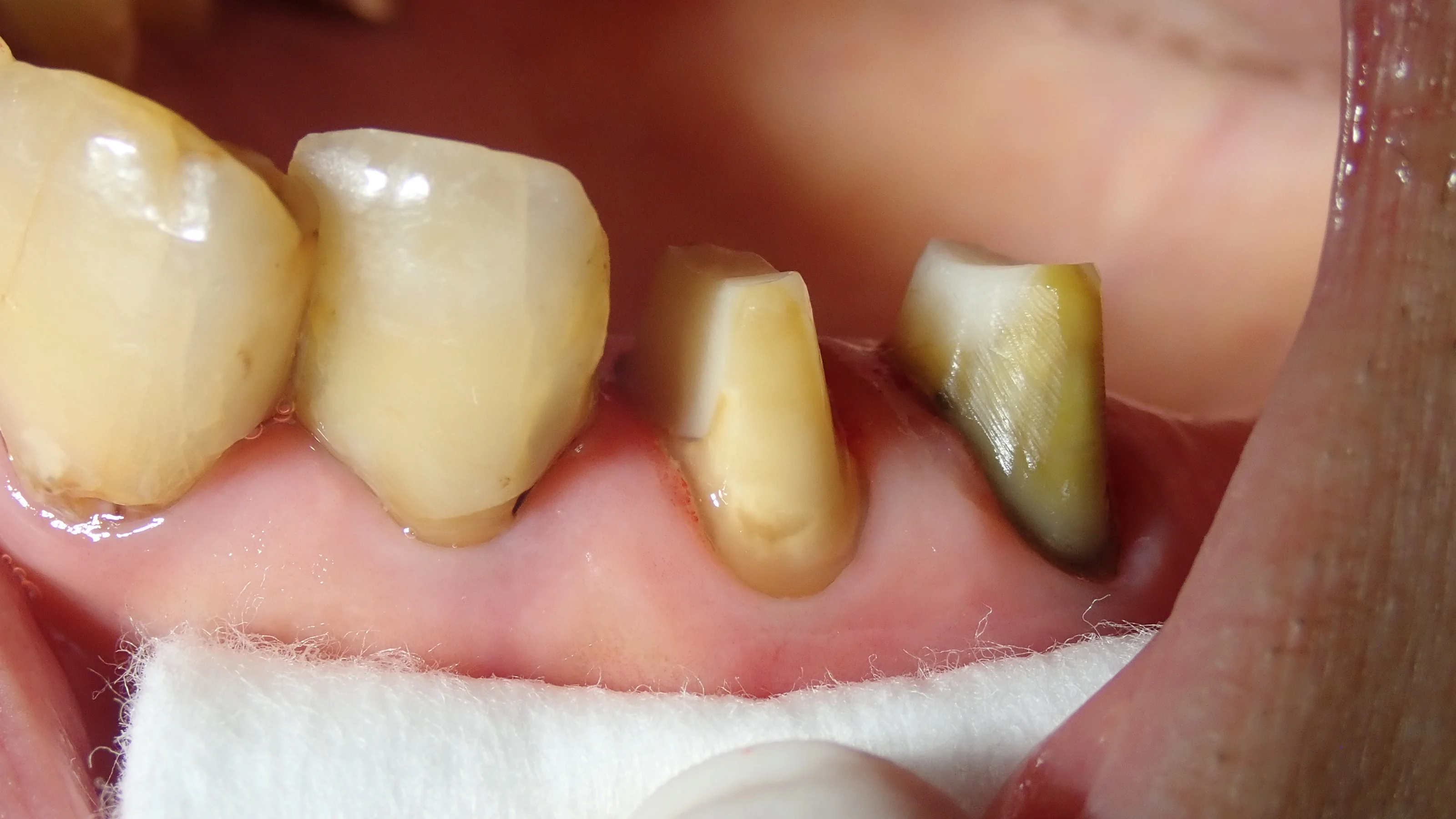 硬質レジンジャケット冠|坂寄歯科医院(取手市藤代) - 画像2