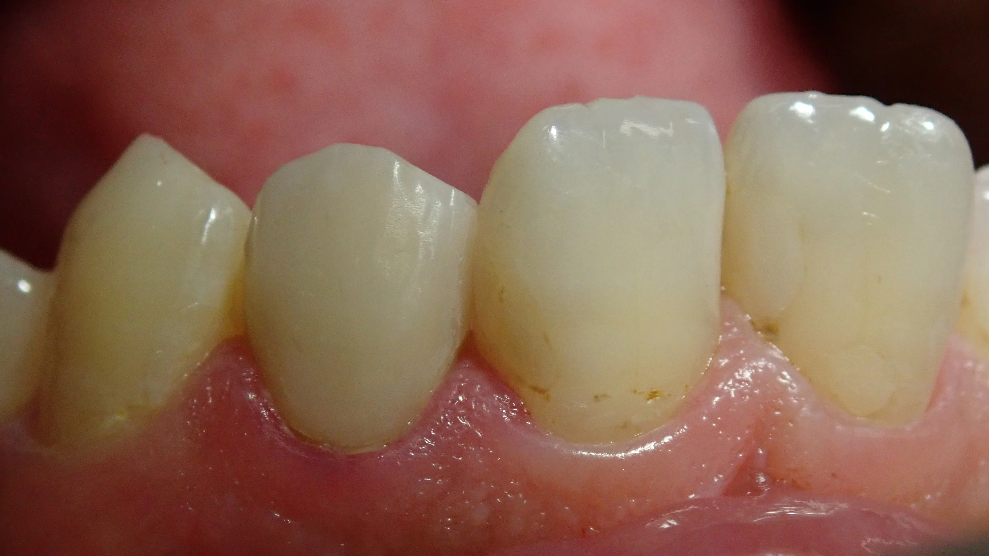 前歯のダイレクトベニア|坂寄歯科医院(取手市藤代) - 画像4