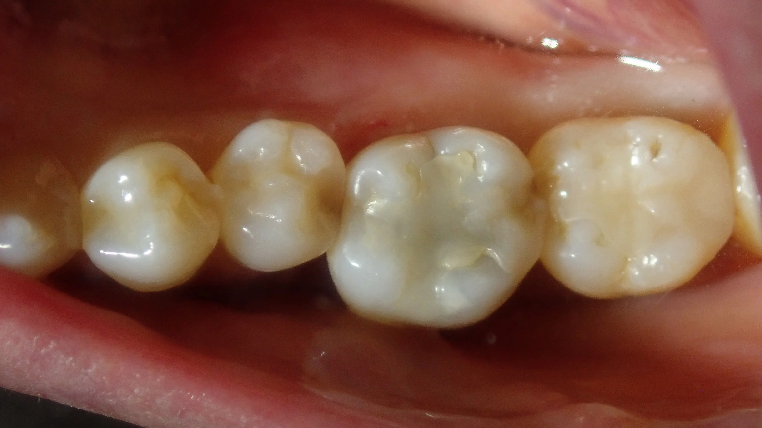 ダイレクトボンディング⑦|坂寄歯科医院(取手市藤代)