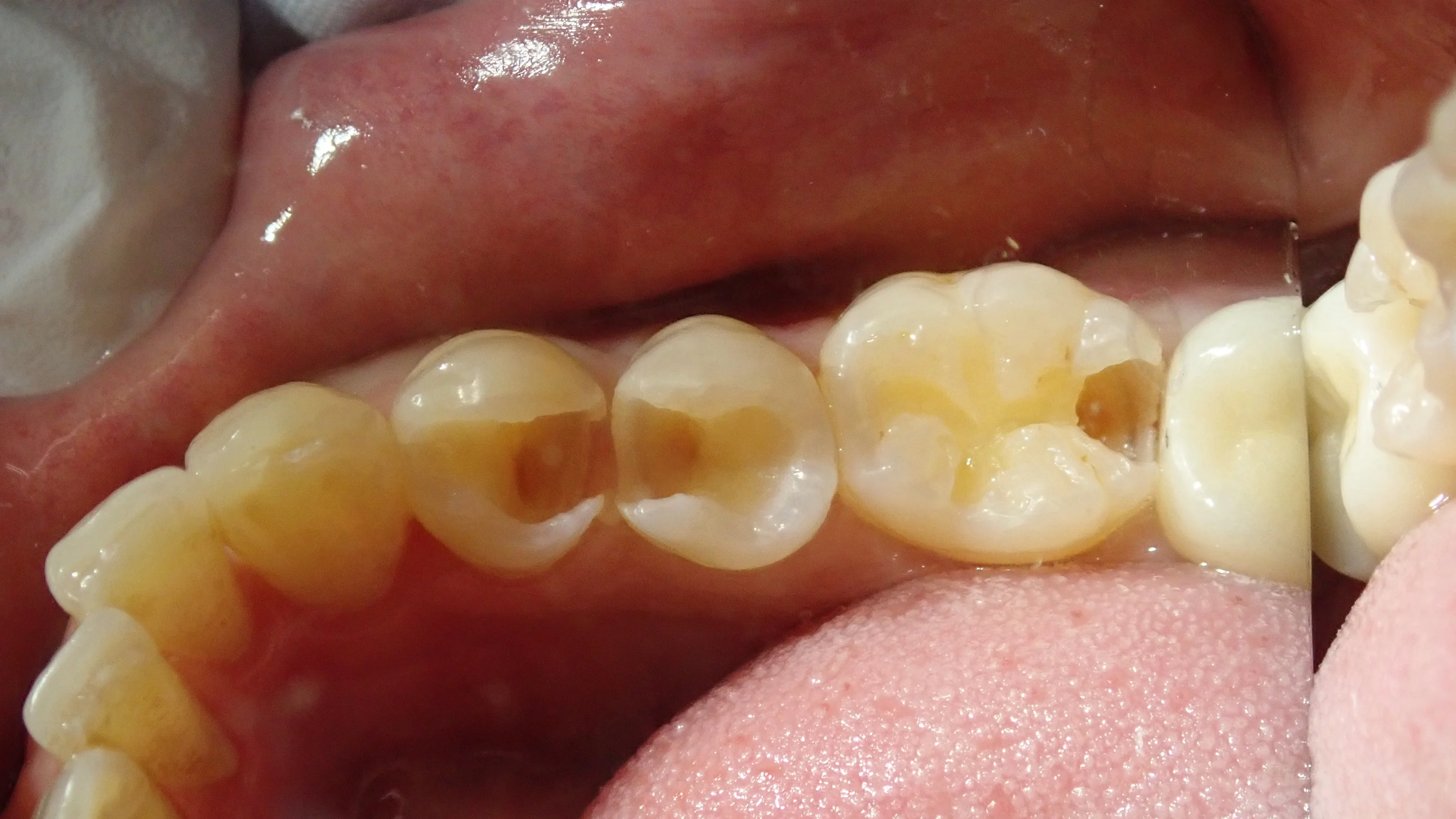 保険の白い詰め物(一気に3本)|坂寄歯科医院(取手市藤代) - 画像3