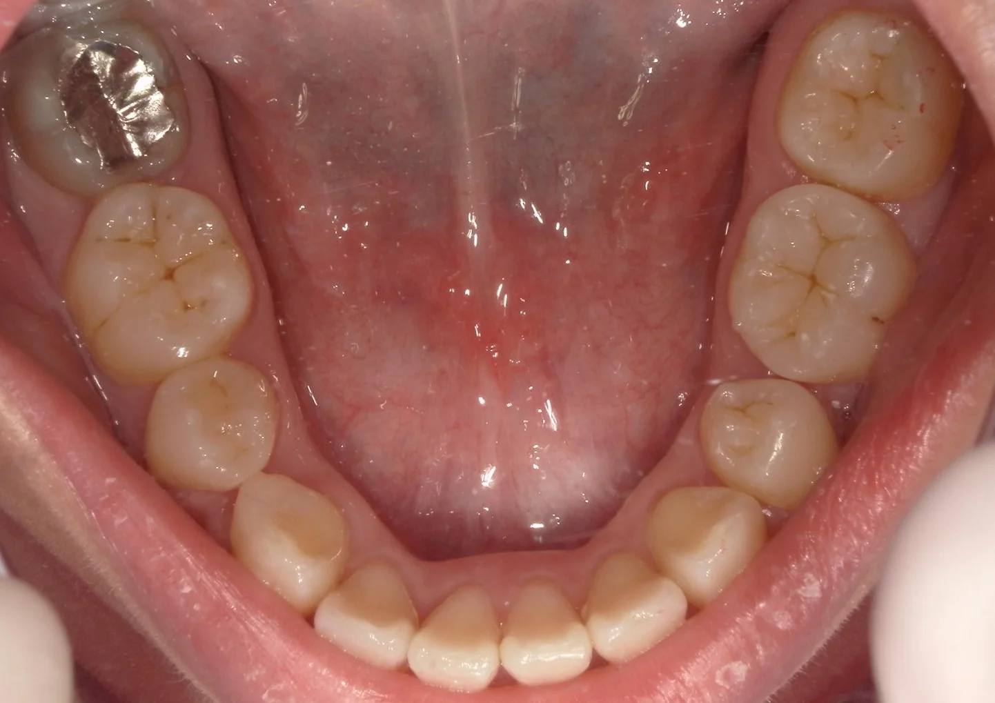 全顎的に白い詰め物で治した症例|坂寄歯科医院(取手市藤代) - 画像2