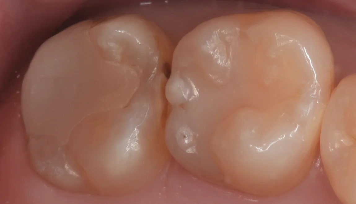 他院で入れたセラミックをダイレクトボンディングに。|坂寄歯科医院(取手市藤代)