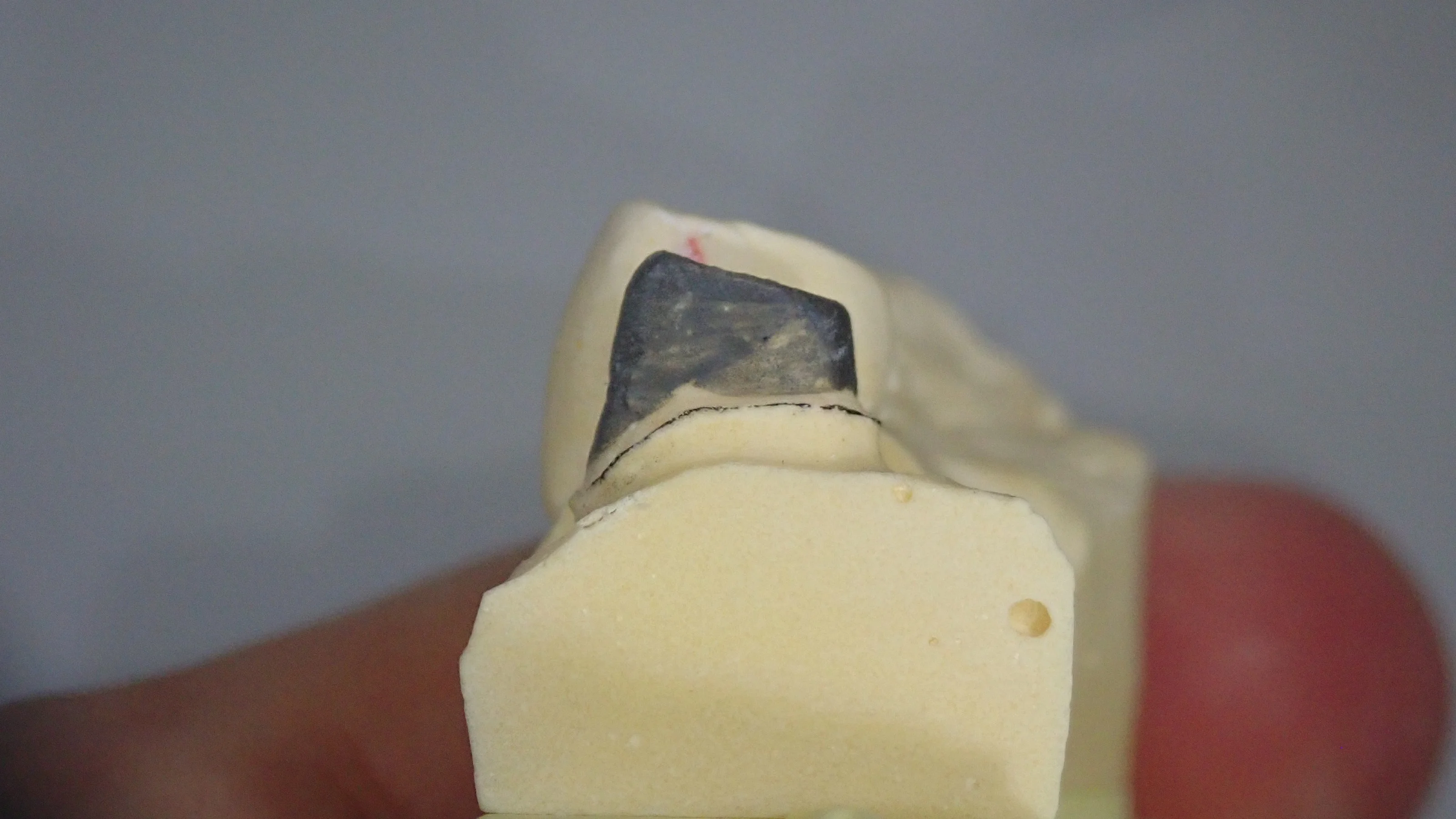 メタルクラウン|坂寄歯科医院(取手市藤代) - 画像2