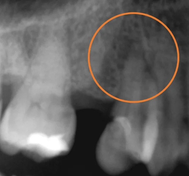 ダイレクトボンディング④|坂寄歯科医院(取手市藤代) - 画像2