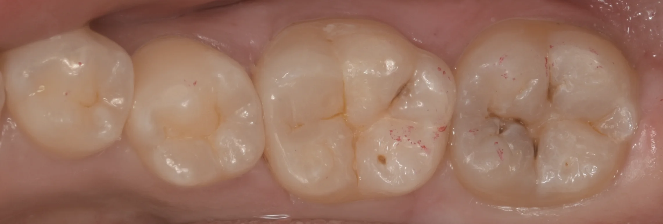 浦安から来た方をダイレクトボンディングで。｜坂寄歯科医院（取手市藤代） - 画像4