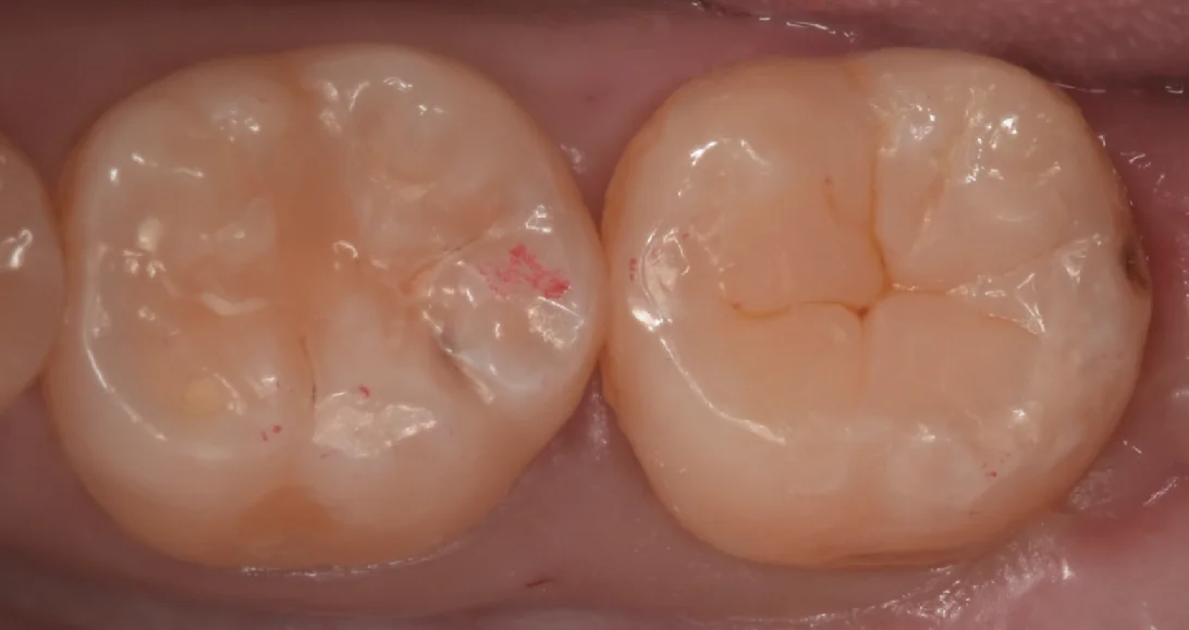 鎌倉からダイレクトボンディングを希望して｜坂寄歯科医院（取手市藤代） - 画像3