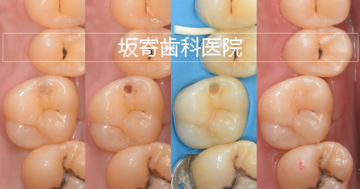 ダイレクトボンディング症例