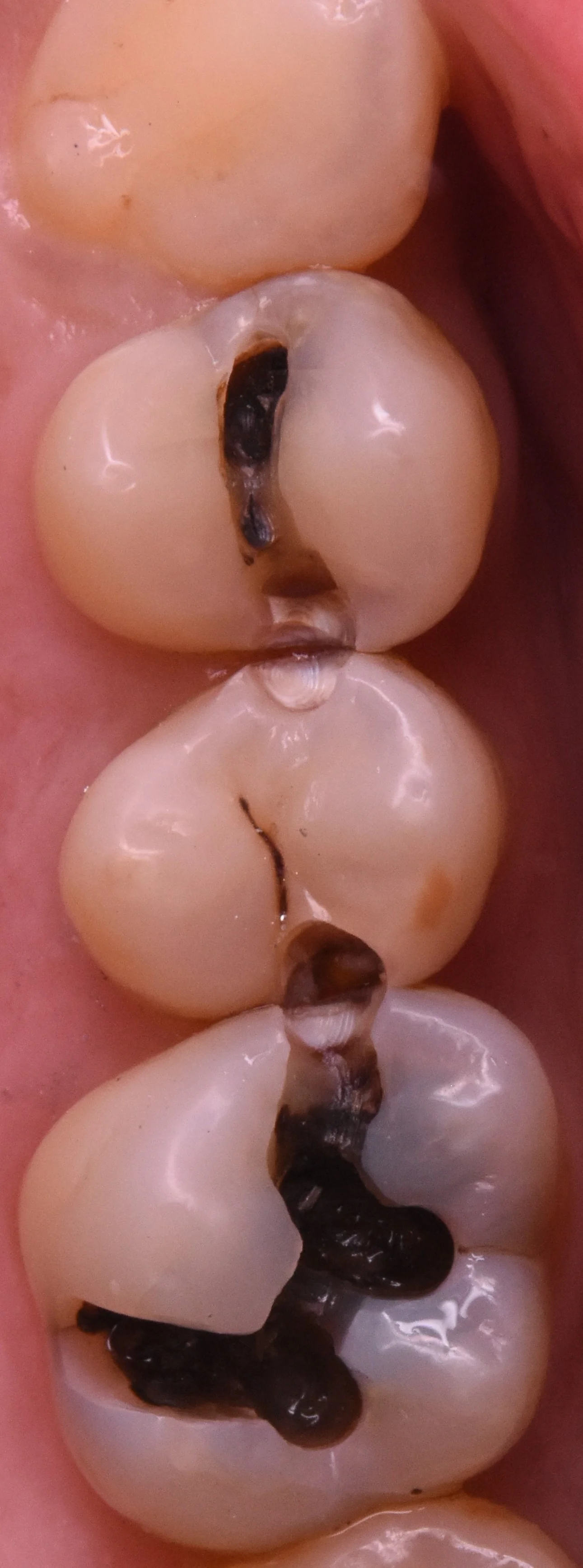 奥歯3本を纏めて一気に治療。|坂寄歯科医院(取手市藤代) - 画像2