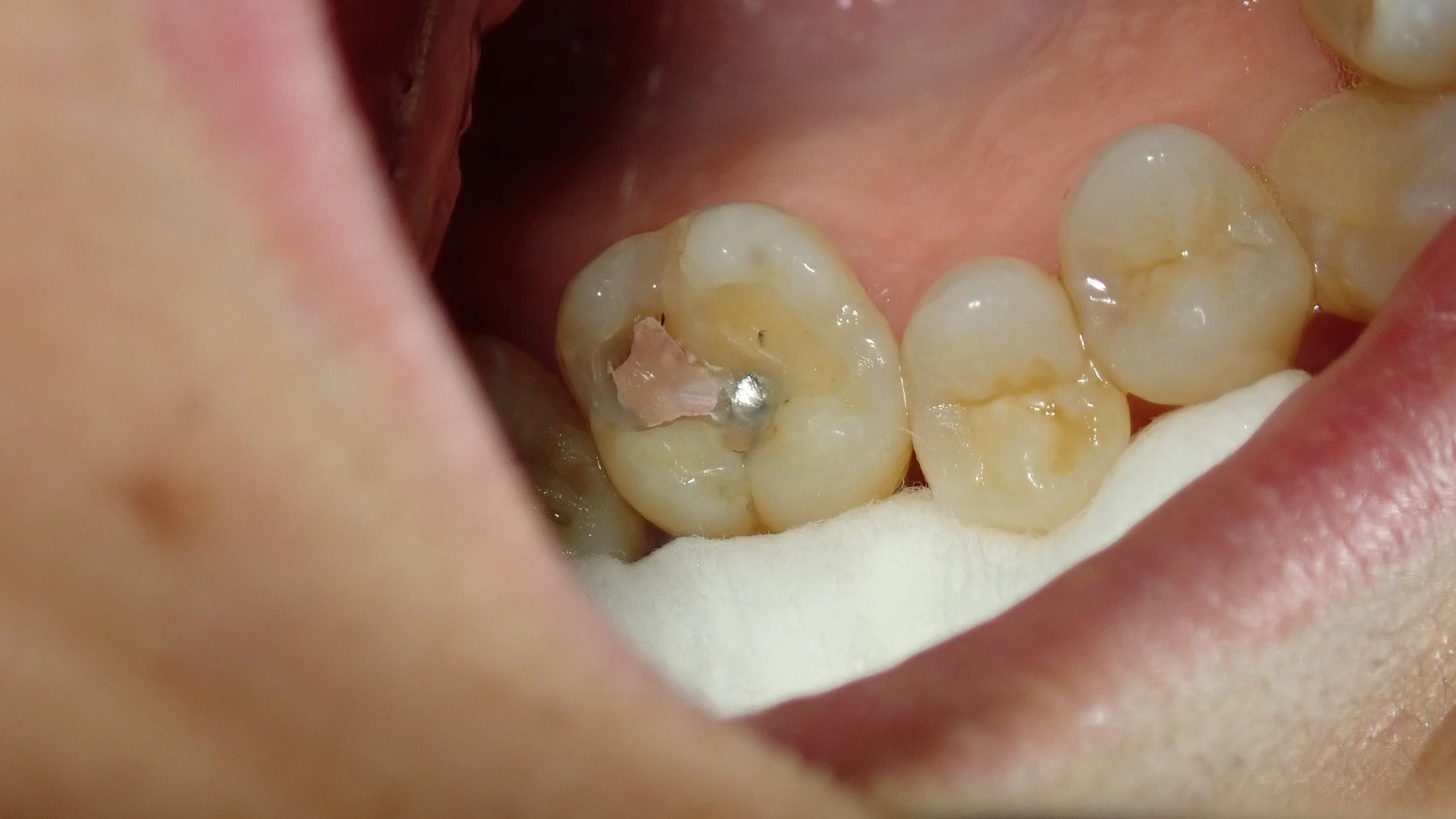 右上6ダイレクトボンディング|坂寄歯科医院(取手市藤代) - 画像2