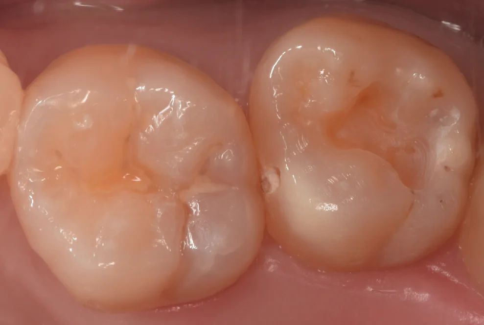 新しくできた虫歯と古い詰め物を同時に治療。｜坂寄歯科医院（取手市藤代） - 画像2