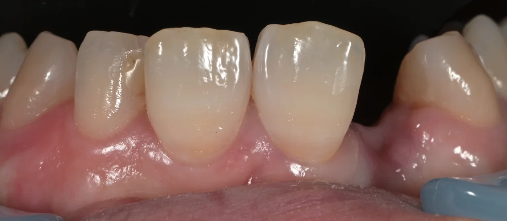 審美治療+歯質保存:延長セラミックブリッジ|坂寄歯科医院(取手市藤代)