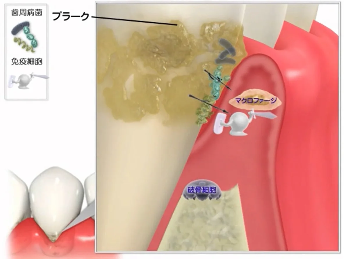 Q&A~歯周病ってなに?②~|坂寄歯科医院(取手市藤代) - 画像3