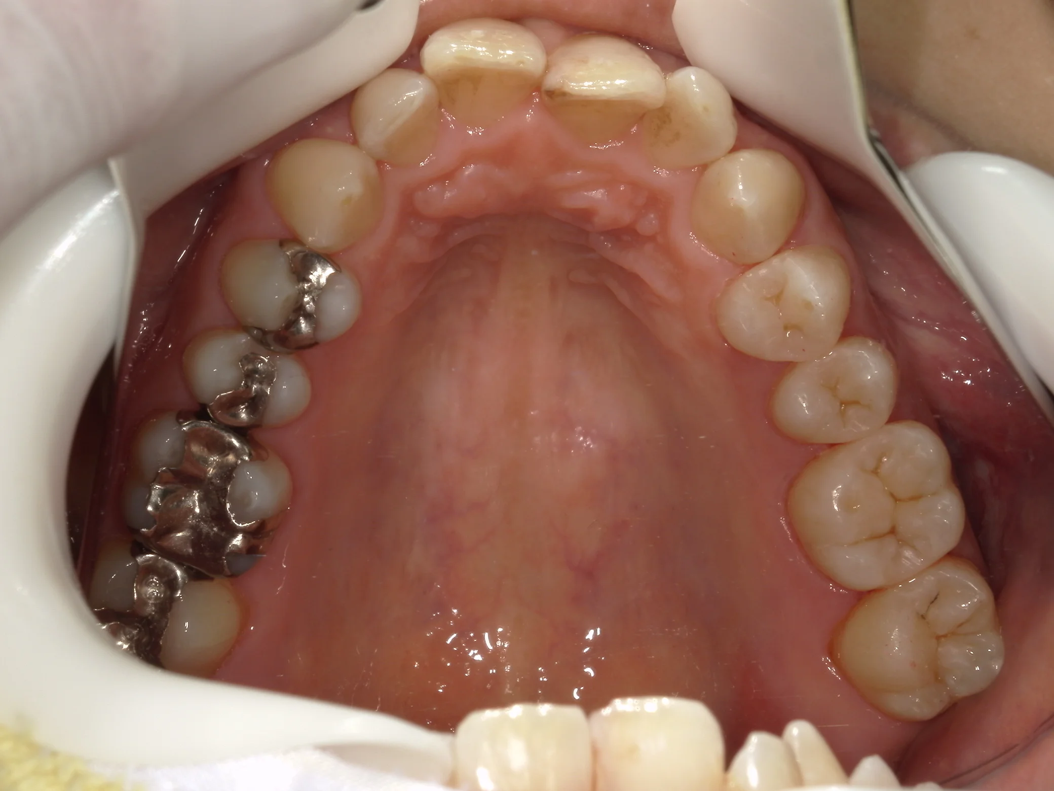 全体的に金属を白くしたいという方の治療｜坂寄歯科医院（取手市藤代） - 画像6