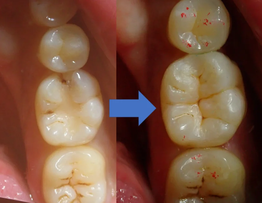 ダイレクトボンディング⑧|坂寄歯科医院(取手市藤代) - 画像6