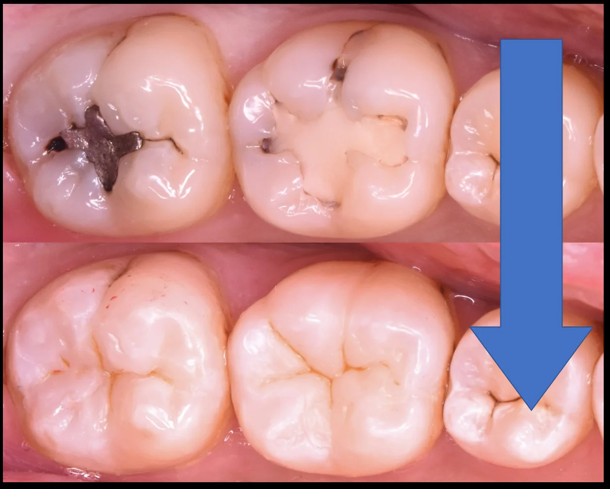 奥歯2本の治療を1日で。|坂寄歯科医院(取手市藤代) - 画像5