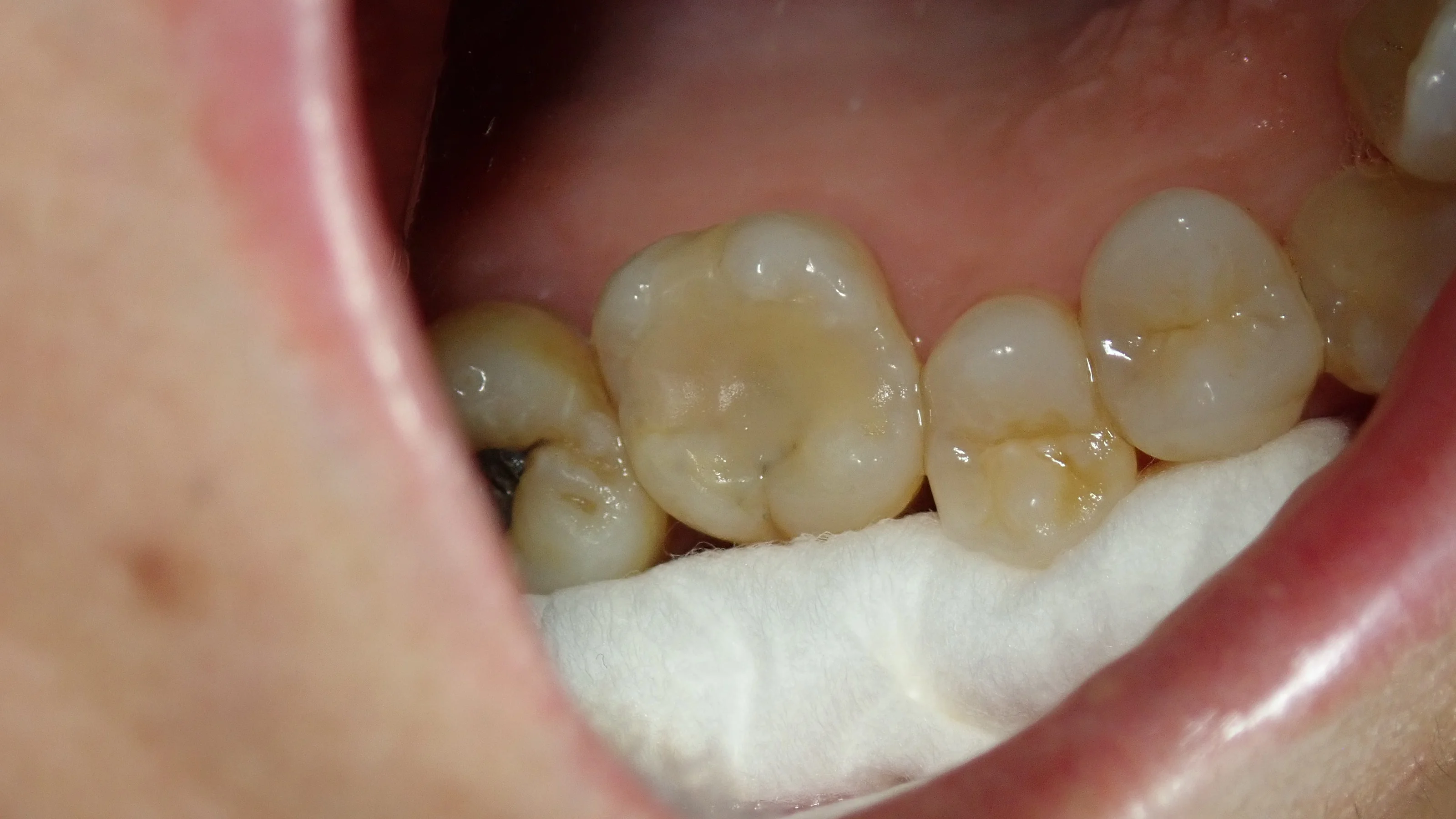 右上6ダイレクトボンディング|坂寄歯科医院(取手市藤代)