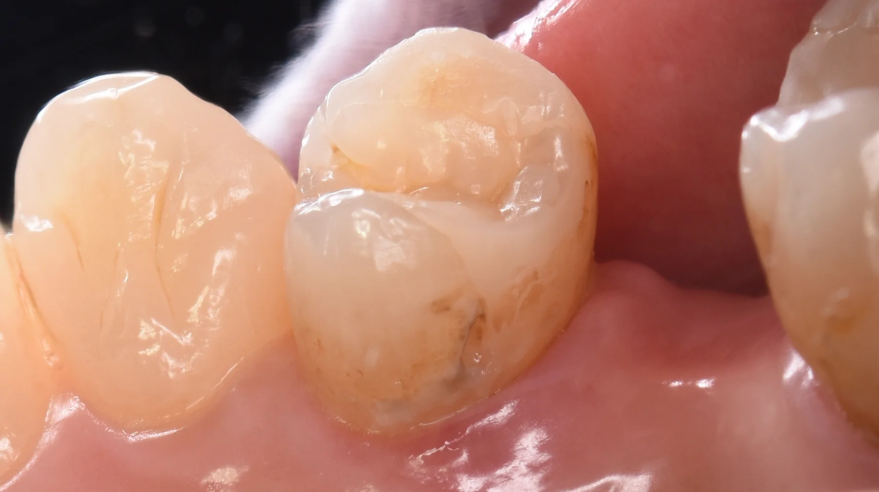 ダイレクトボンディング術後4年での補修修復|坂寄歯科医院(取手市藤代) - 画像2