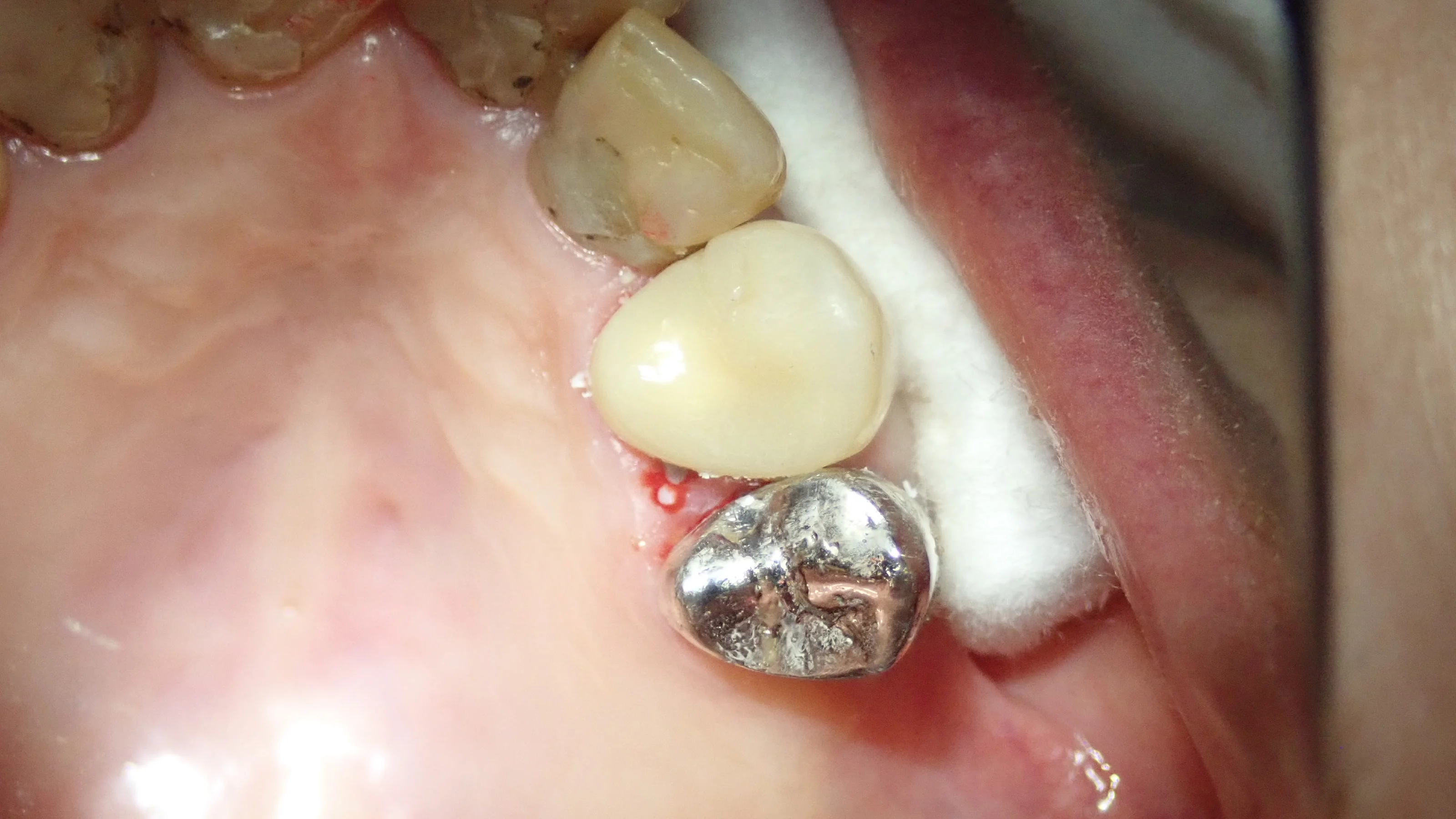 硬質レジンジャケット冠|坂寄歯科医院(取手市藤代) - 画像5