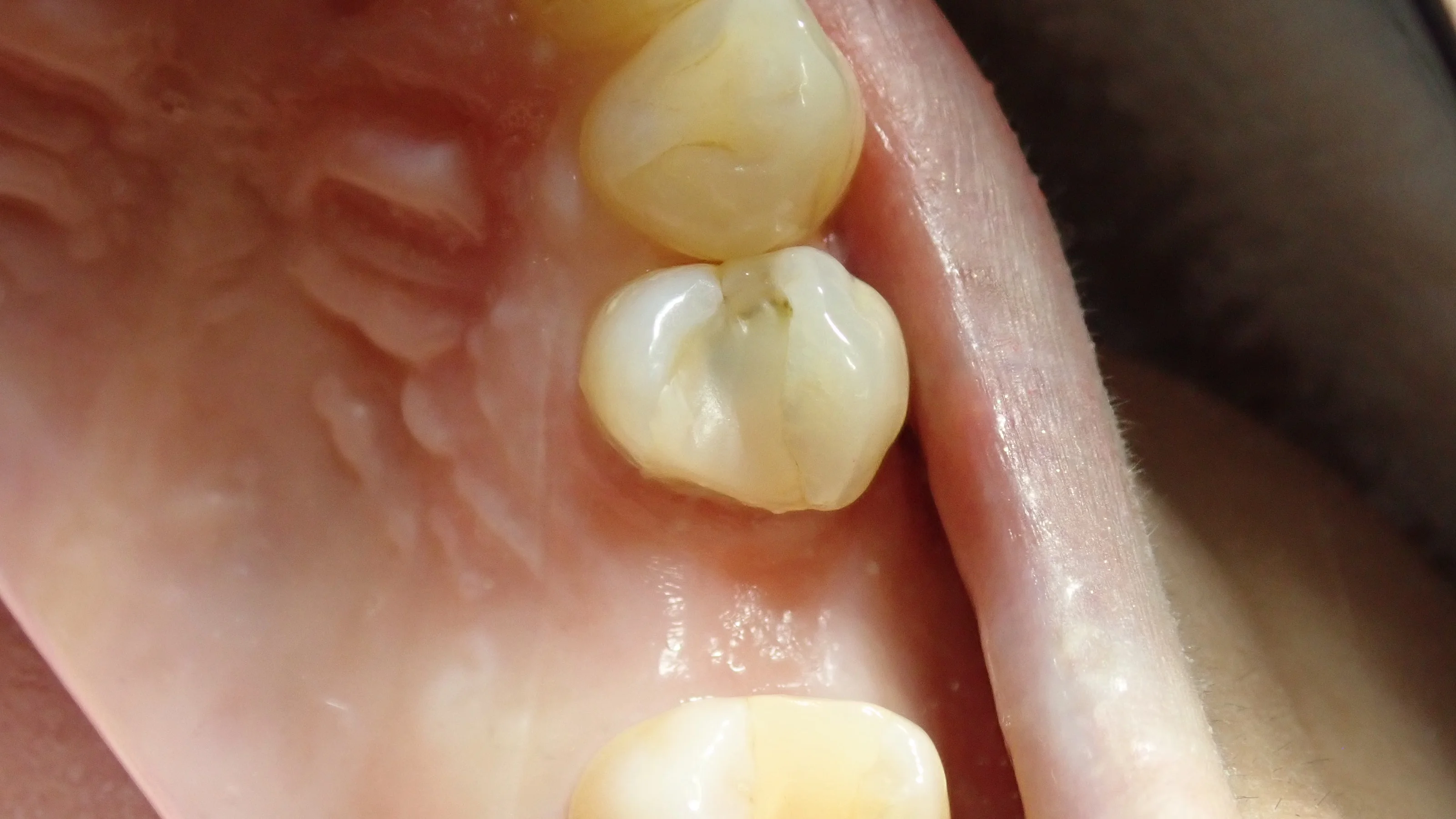 ダイレクトボンディング④|坂寄歯科医院(取手市藤代)