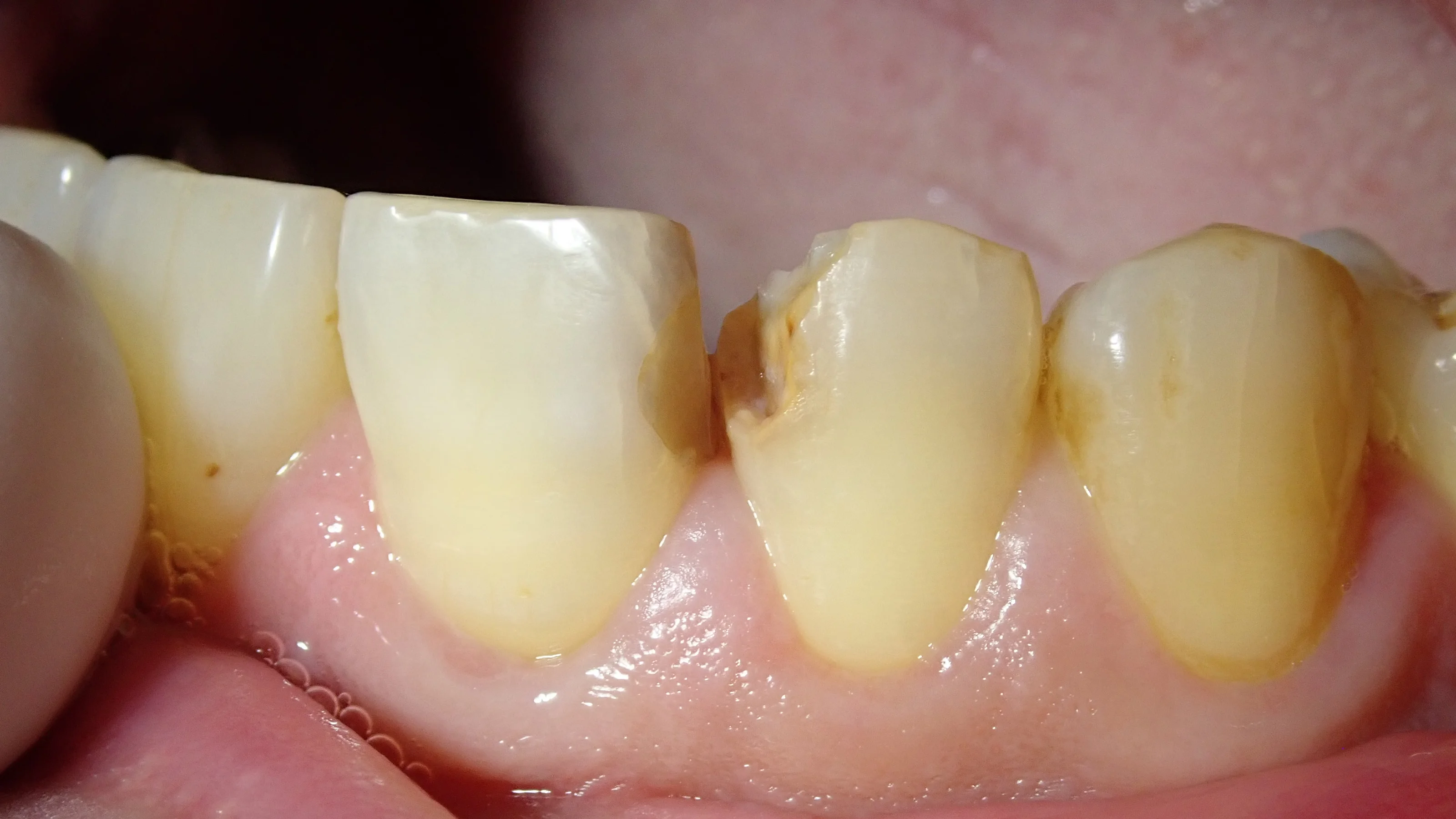 前歯の白い詰め物｜坂寄歯科医院（取手市藤代）