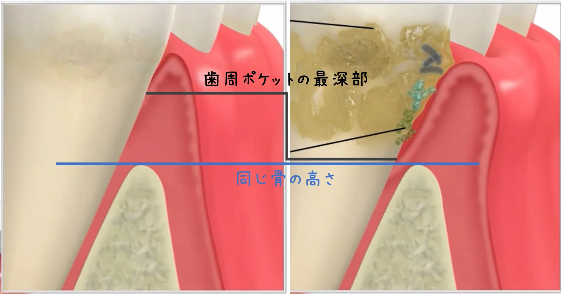 Q&A~歯周病ってなに?②~|坂寄歯科医院(取手市藤代) - 画像2