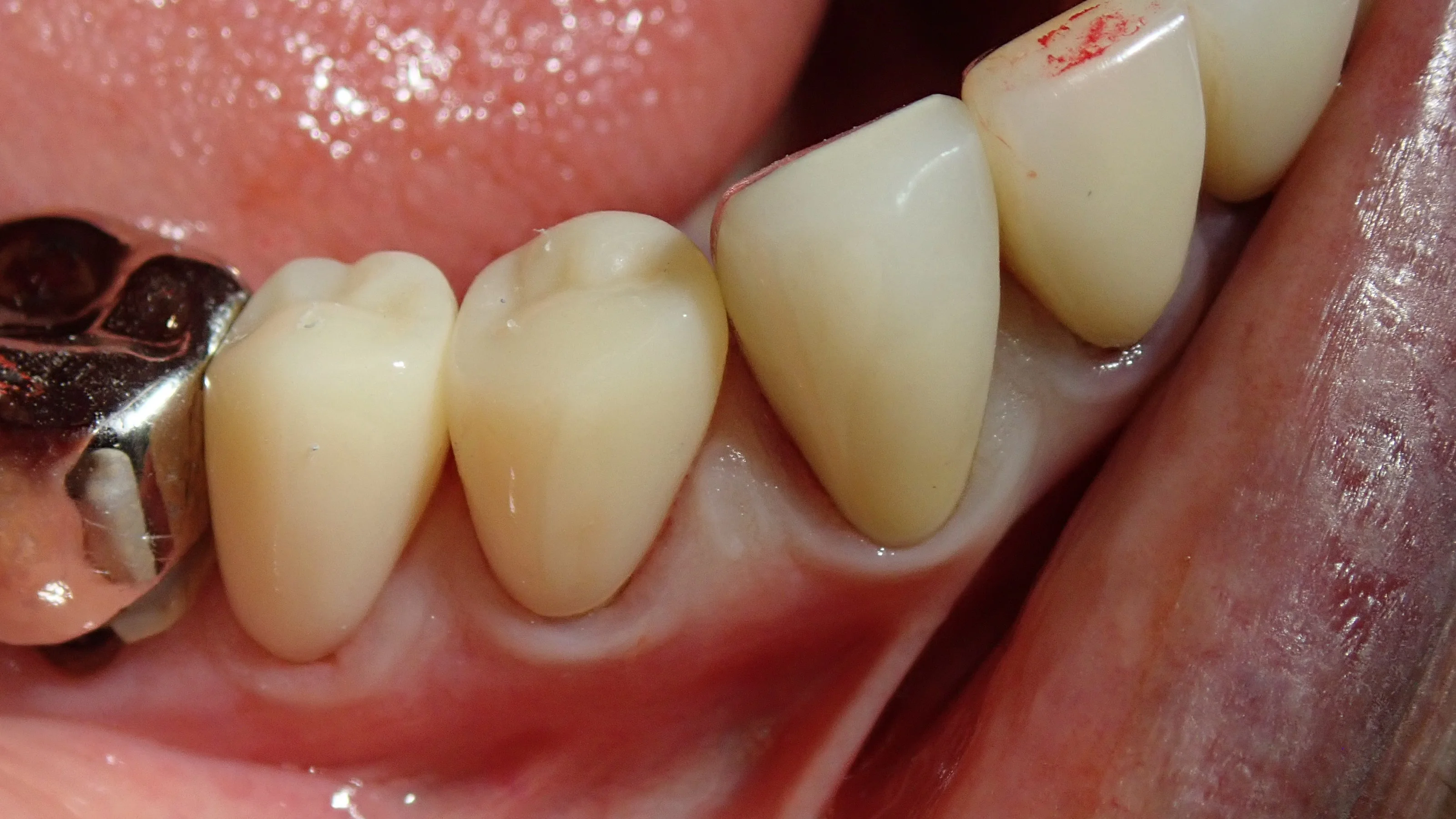 CAD/CAM冠について｜坂寄歯科医院（取手市藤代） - 画像2