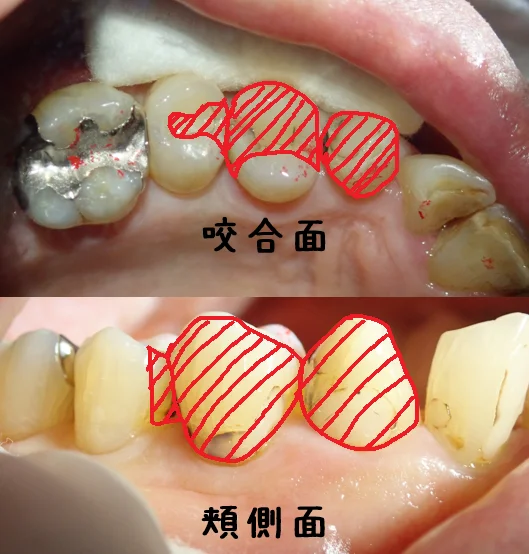 3本連続ダイレクトボンディング|坂寄歯科医院(取手市藤代) - 画像2