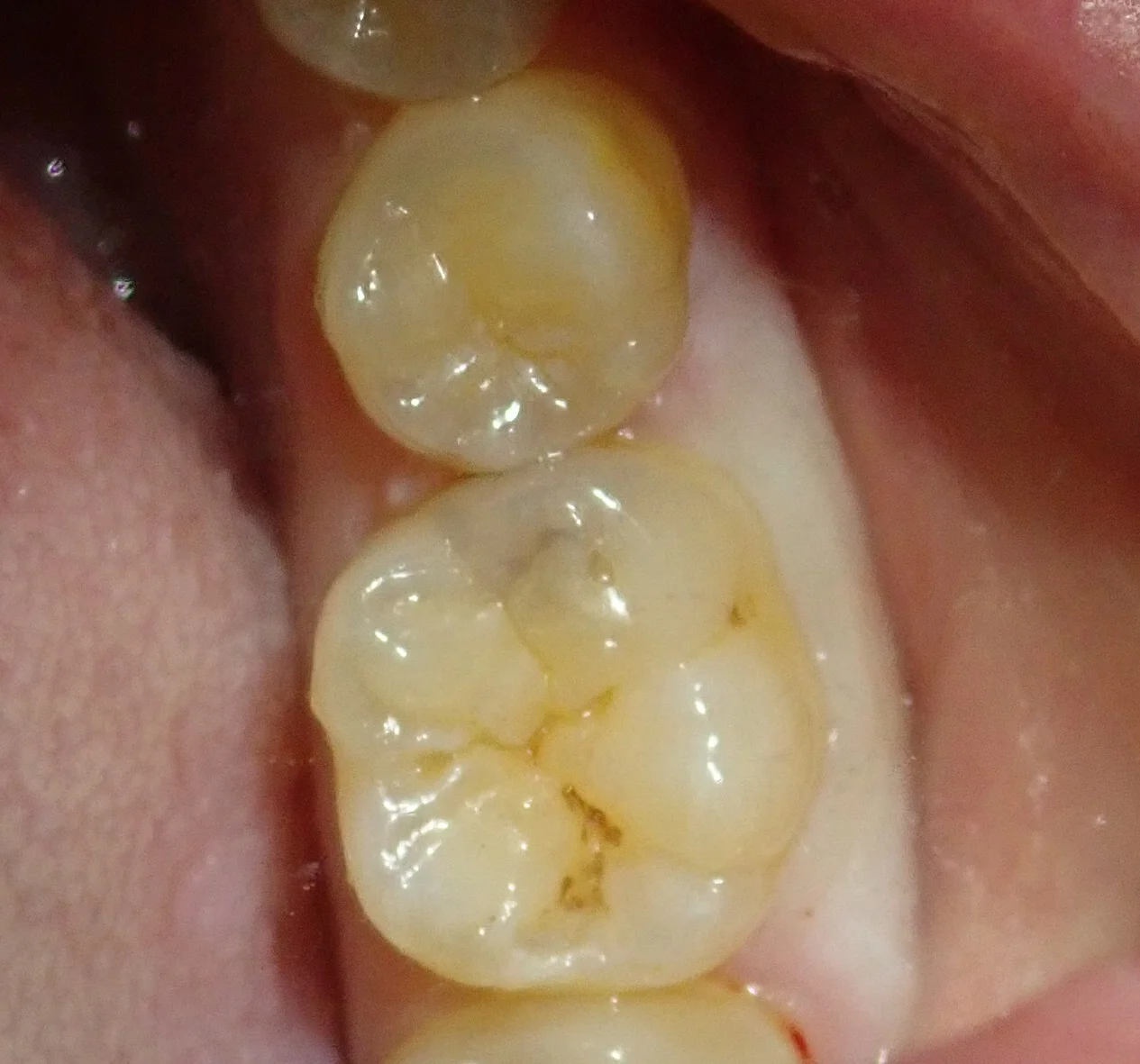 虫歯はない・・・?本当に・・・?|坂寄歯科医院(取手市藤代)