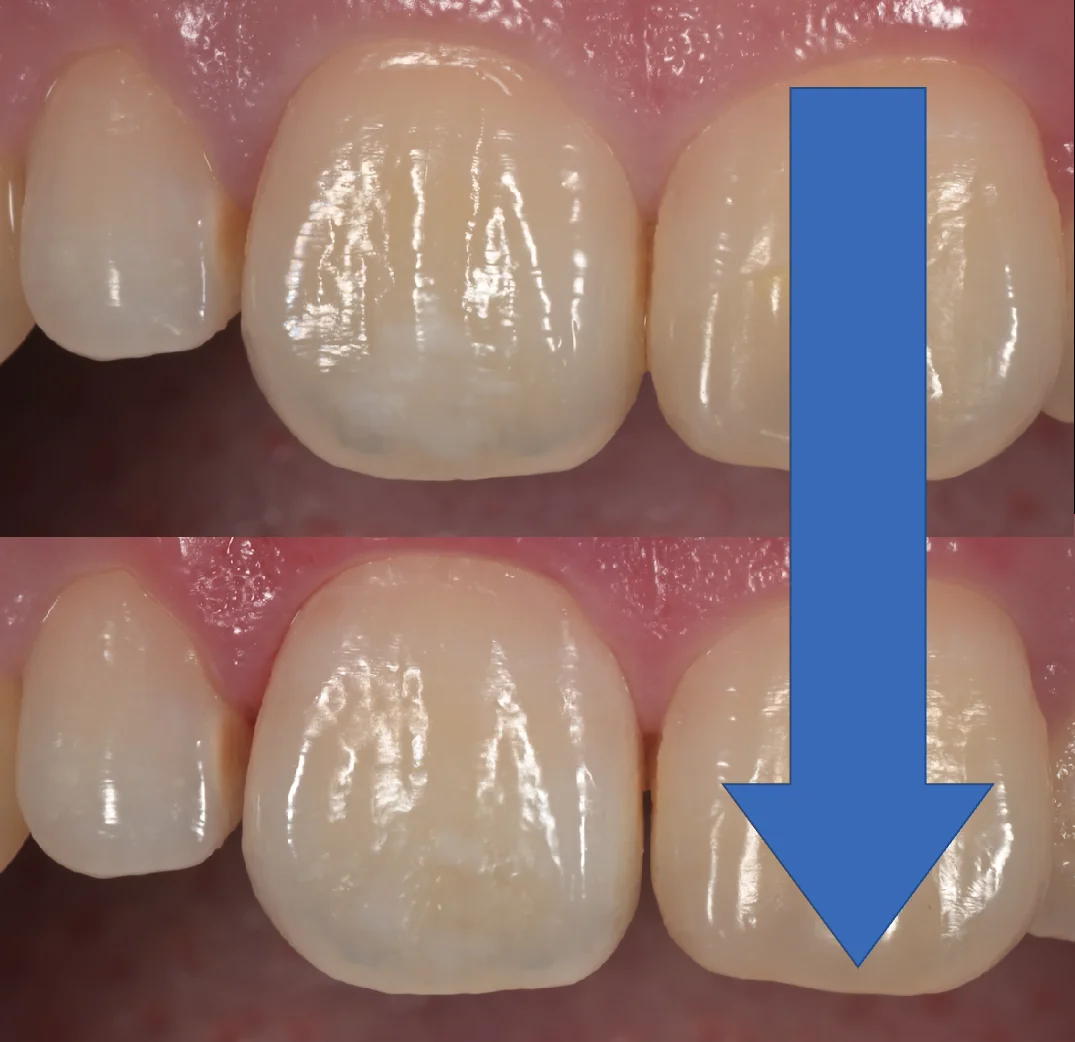 ICON治療にてホワイトスポットを改善。|坂寄歯科医院(取手市藤代) - 画像6